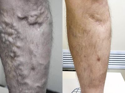 До и после: Расширения вен под коленом
